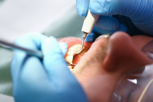 Best Broken or Chipped Tooth Repair in Eldorado, TX